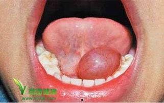 吃瓜压坏舌系带,吃瓜压坏舌系带的意外趣闻